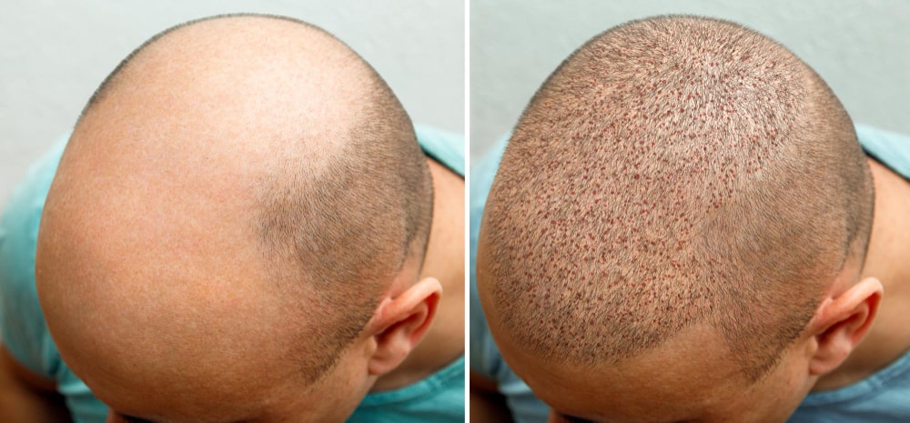 head-balding-man-before-after-hair-transplant-surgery-man-losing-his-hair-has-become (1)-min